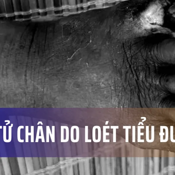 Hoại tử ngón chân nặng do biến chứng tiểu đường