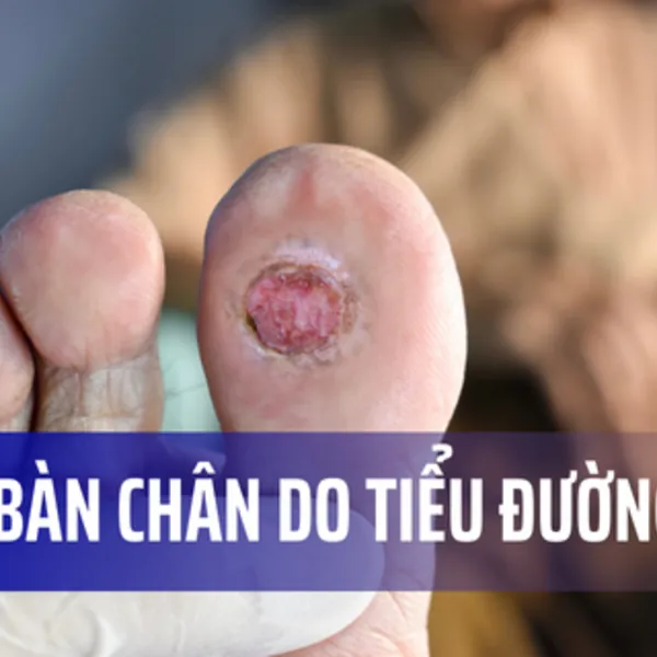 Loét bàn chân do tiểu đường: Những điều bạn cần biết