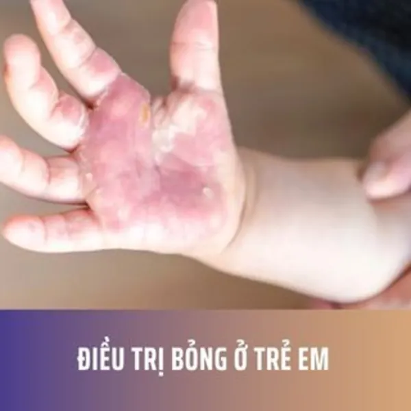 Điều trị bỏng ở trẻ em