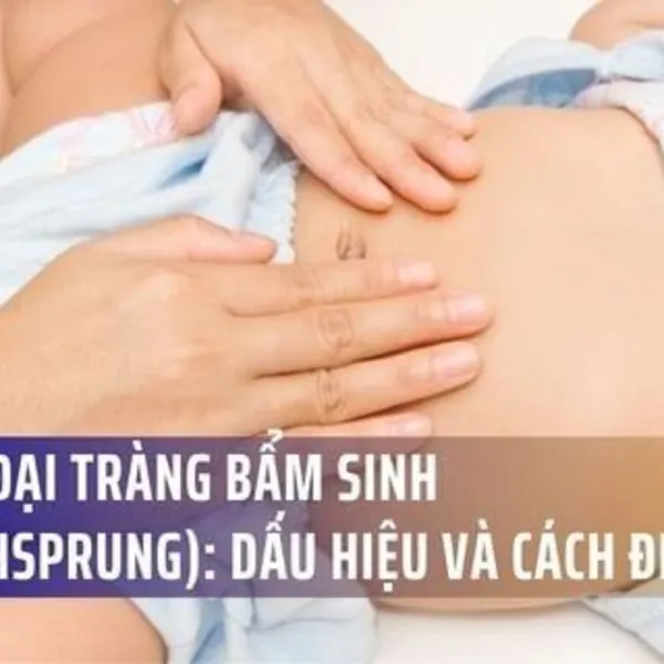 Phình Đại Tràng Bẩm Sinh (Hirschsprung): Dấu Hiệu Và Cách Điều Trị