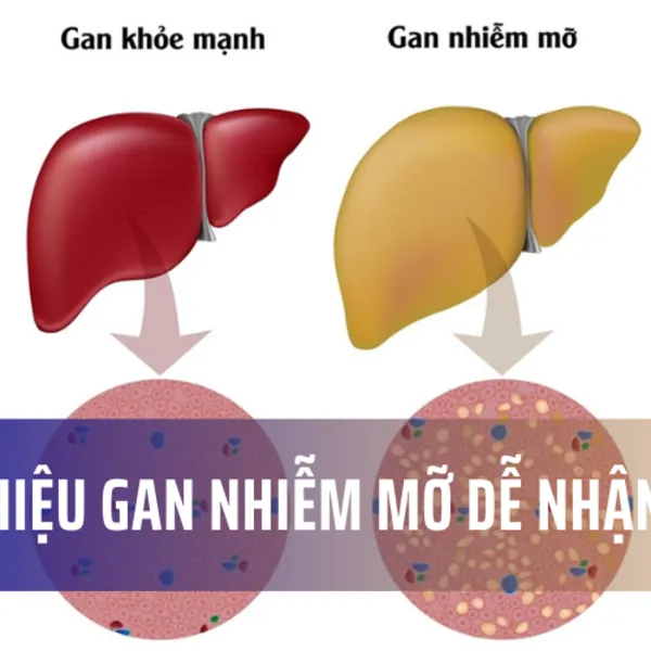 5 dấu hiệu gan nhiễm mỡ dễ nhận thấy