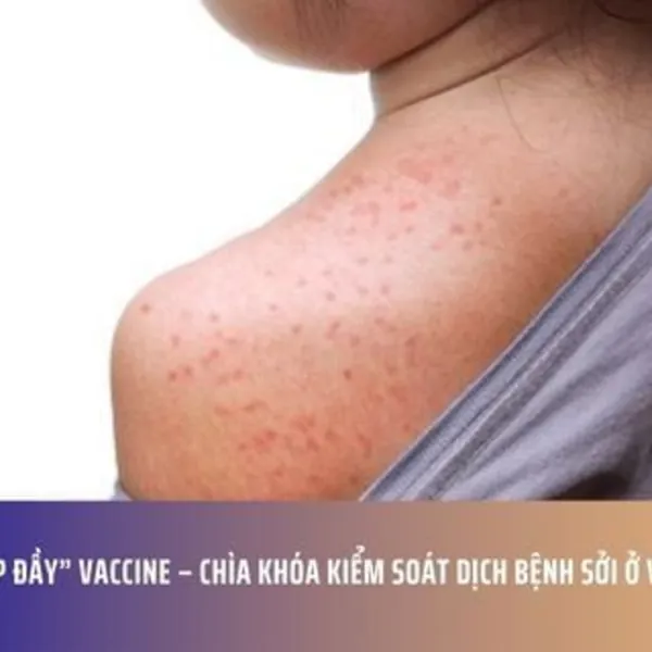 “Lấp đầy” vaccine – Chìa khóa kiểm soát dịch bệnh sởi ở vùng cao