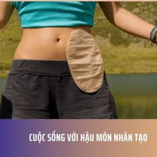 Cuộc sống với Hậu Môn Nhân Tạo