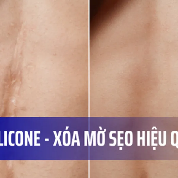 Gel silicone - Giải pháp xóa mờ sẹo trên mặt và cơ thể hiệu quả