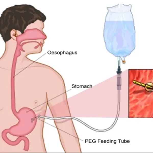 Rủi ro nuôi ăn đường ruột qua ống thông dạ dày