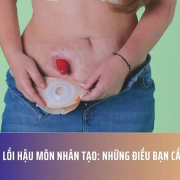 Sa Lồi Hậu Môn Nhân Tạo: Những Điều Bạn Cần Biết