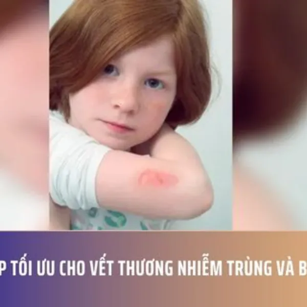 Giải Pháp Tối Ưu Cho Vết Thương Nhiễm Trùng Và Bỏng Ở Trẻ