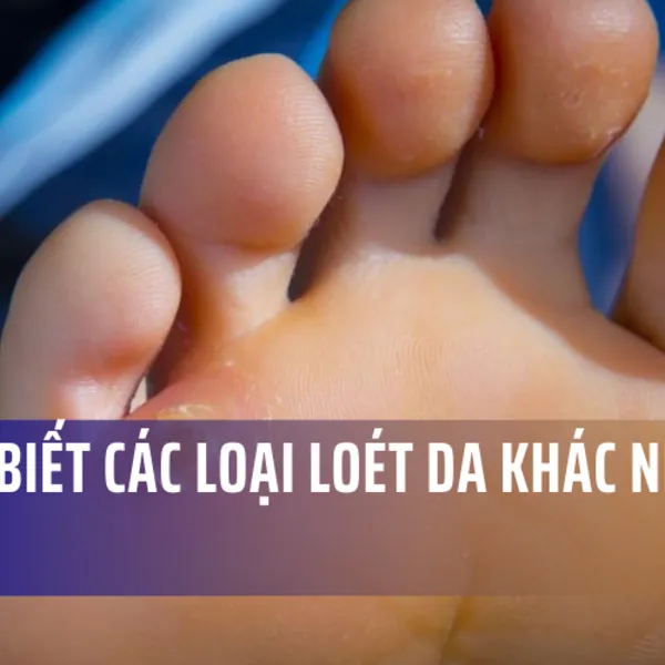 Bạn đã biết các loại loét da khác nhau chưa? (Phần 2)