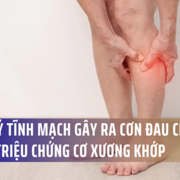 Các Bệnh Lý Tĩnh Mạch Gây Ra Cơn Đau Chân Mang Triệu Chứng Cơ Xương Khớp