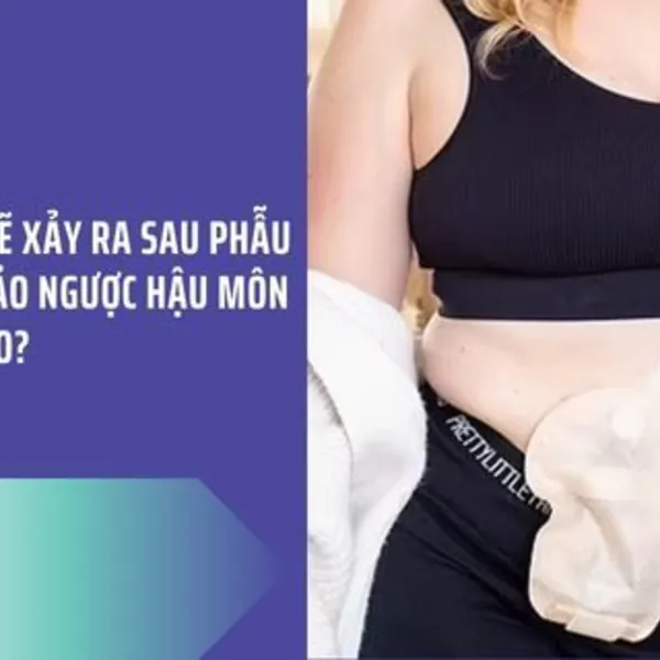 Điều gì sẽ xảy ra sau phẫu thuật đảo ngược hậu môn nhân tạo?