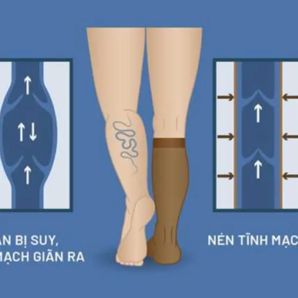 Dùng Tất nén/Vớ nén có ích lợi gì khi bị cục máu đông, suy giãn tĩnh mạch, hay chân sưng đau?