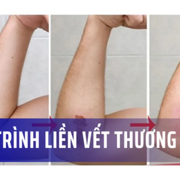 Quá trình liền vết thương diễn ra như thế nào?