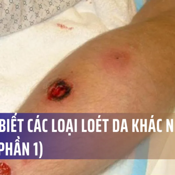 Bạn đã biết các loại loét da khác nhau chưa? (Phần 1)