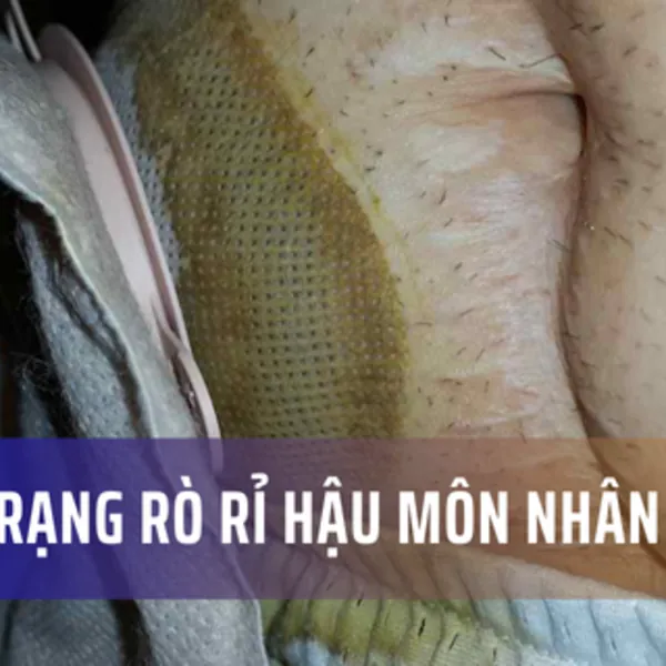 Rò rỉ hậu môn nhân tạo: Tình trạng chung và Biểu hiện