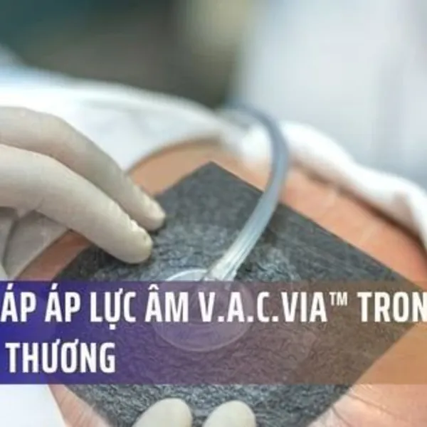 Liệu pháp áp lực âm V.A.C.Via™ trong điều trị vết thương