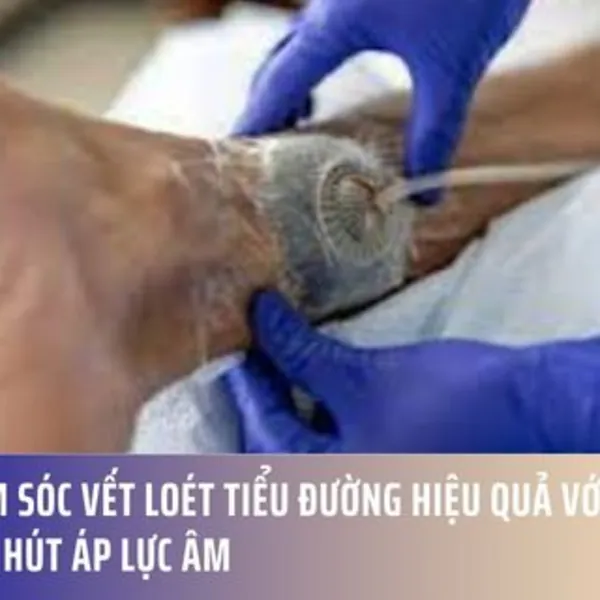 Chăm sóc vết loét tiểu đường hiệu quả với giải pháp hút áp lực âm
