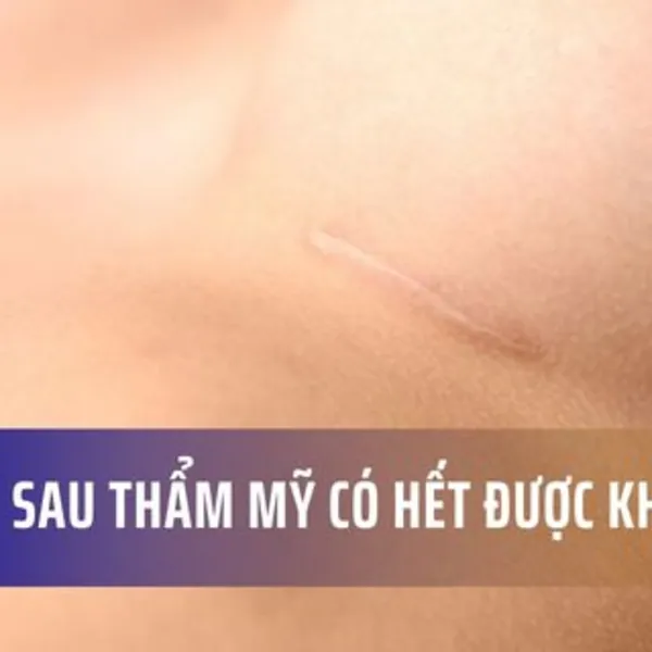 Sẹo lồi sau phẫu thuật thẩm mỹ có hết được không?