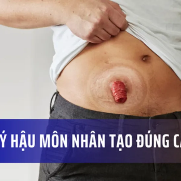 Quản lý các loại hậu môn nhân tạo khác nhau