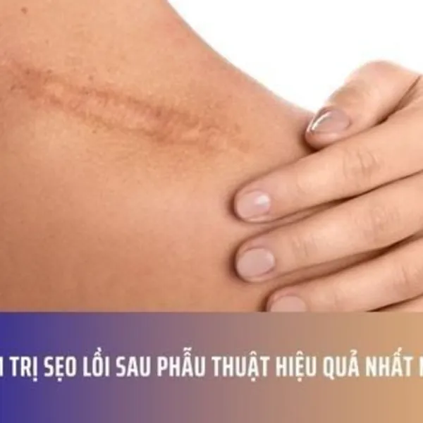 Top 7 kem trị sẹo lồi sau phẫu thuật hiệu quả nhất năm 2025
