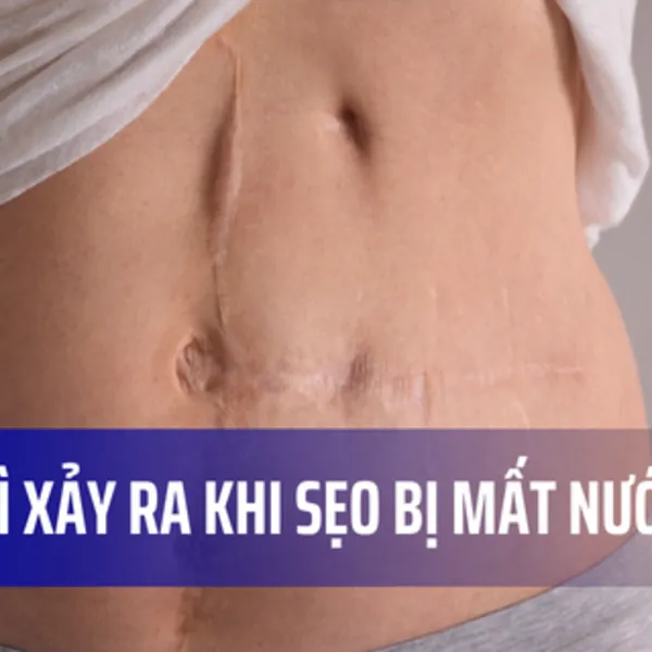 Điều gì xảy ra khi sẹo bị mất nước?