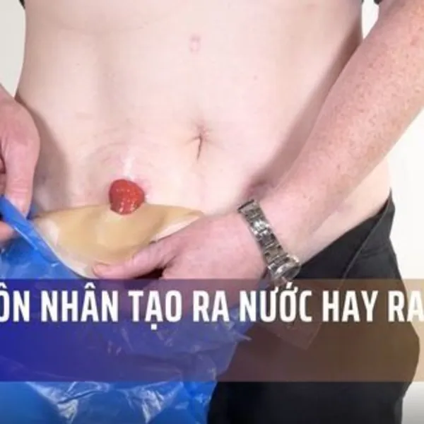 Hậu môn nhân tạo ra nước hay ra phân đặc