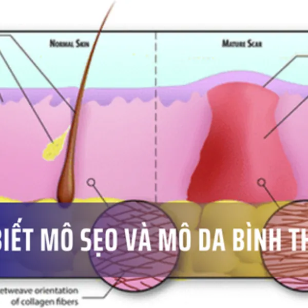 Nhận biết mô sẹo và mô da bình thường
