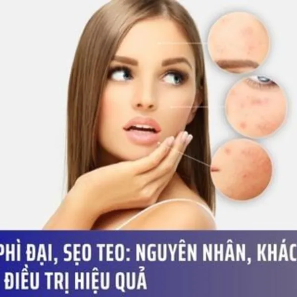 Sẹo Phì Đại và Sẹo Teo: Nguyên Nhân, Khác Biệt & Cách Điều Trị Hiệu Quả
