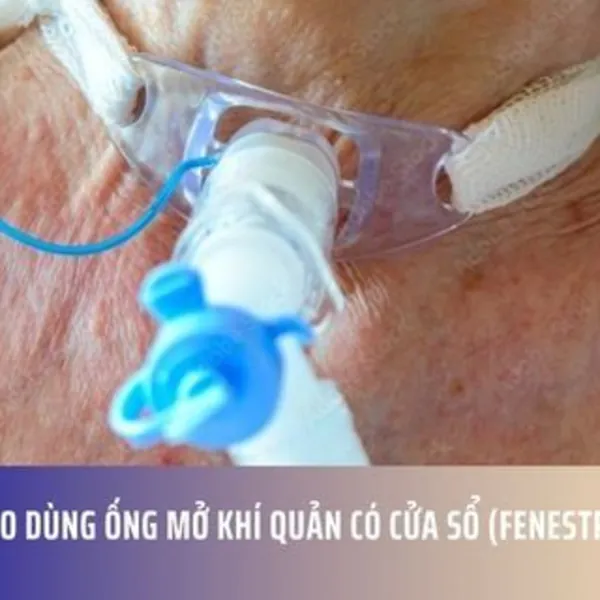 Khi nào dùng ống mở khí quản có cửa sổ (fenestrated)?