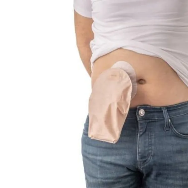 Có thể bạn chưa biết về Hậu Môn Nhân Tạo: Thay Túi và Vệ Sinh