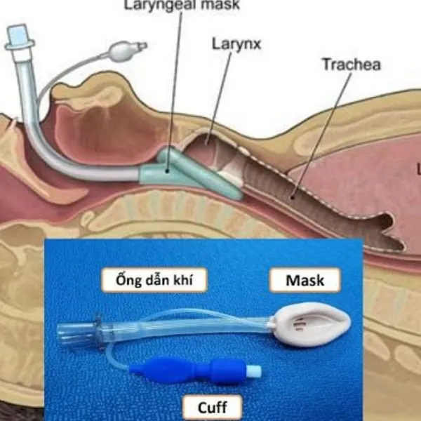 Tìm hiểu thêm về Mask Thanh Quản