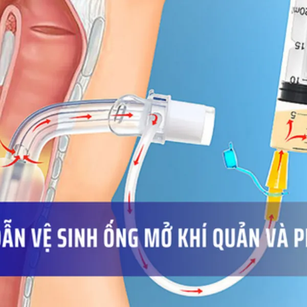 Hướng dẫn vệ sinh ống mở khí quản và các phụ kiện