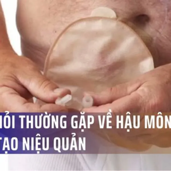 7 câu hỏi thường gặp về hậu môn nhân tạo niệu quản