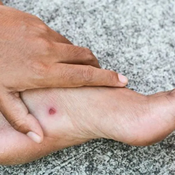 Loét Da Và Cách Phòng Ngừa Hiệu Quả