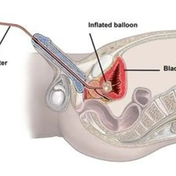 Dẫn lưu nước tiểu