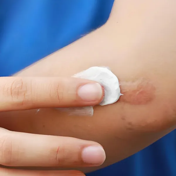 Bị sẹo lồi nên bôi gì? Giải pháp hiệu quả cho sẹo lồi