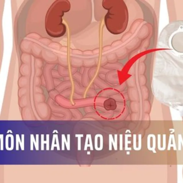 Hậu môn nhân tạo niệu quản: Những điều bạn cần biết