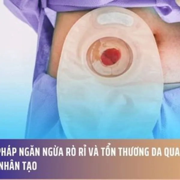 Giải Pháp Ngăn Ngừa Rò Rỉ và Tổn Thương Da Quanh Hậu Môn Nhân Tạo