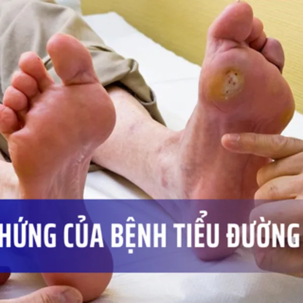 Hãy cẩn thận trước những biến chứng của bệnh tiểu đường