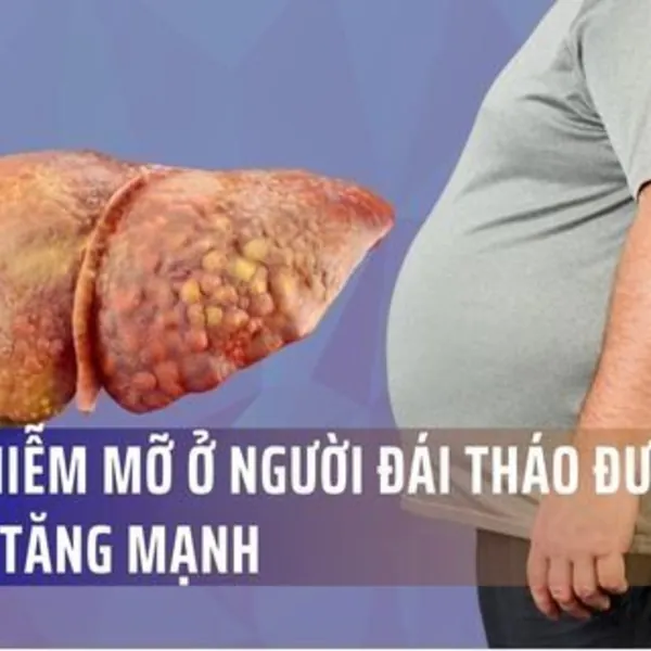Gan nhiễm mỡ ở người đái tháo đường type 2 tăng mạnh