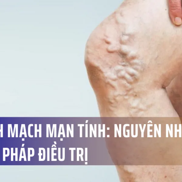 Suy tĩnh mạch : Nguyên nhân và phương pháp điều trị