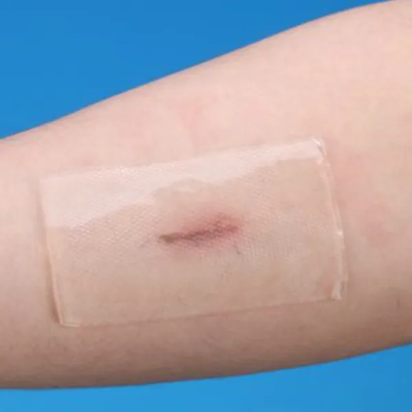 Sau khi mổ bao lâu thì dùng được miếng dán sẹo?