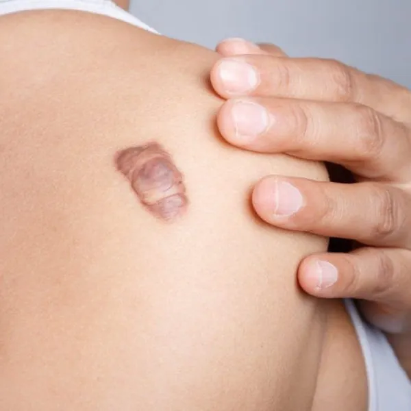 Cách điều trị sẹo lồi mới hình thành