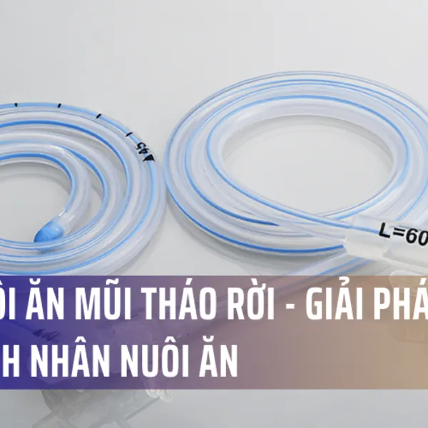 Dây nuôi ăn mũi tháo rời - giải pháp mới cho bệnh nhân nuôi ăn