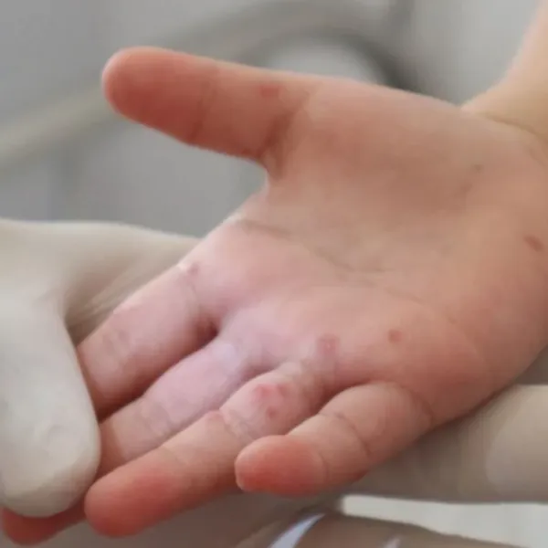 Đắk Lắk: Bệnh nhi 2 tuổi tử vong vì bệnh tay chân miệng