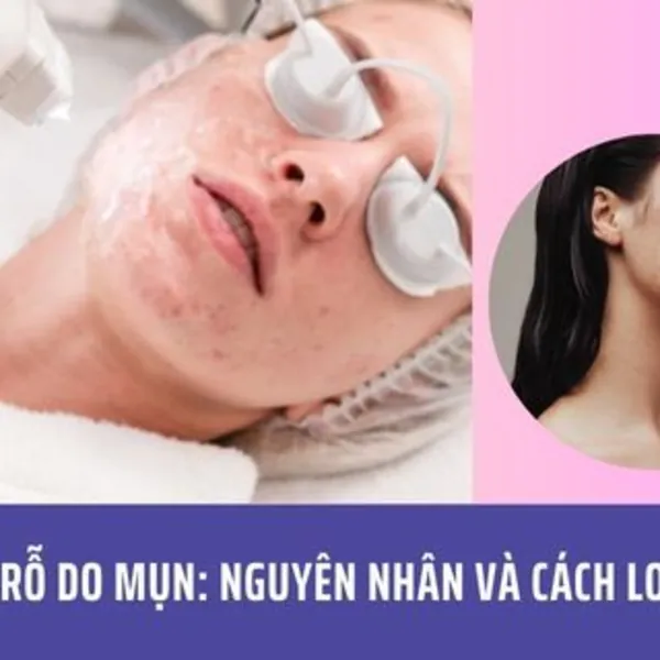 Sẹo Rỗ Do Mụn: Nguyên Nhân Và Cách Loại Bỏ