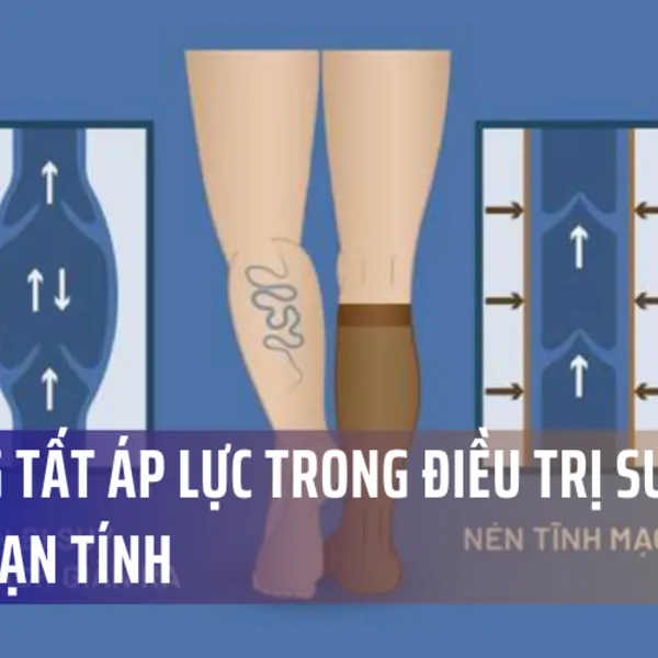 Sử dụng tất áp lực trong điều trị suy tĩnh mạch mạn tính