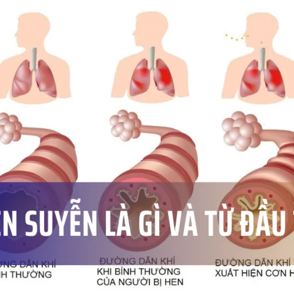 Cơn hen suyễn là gì và từ đầu tới?
