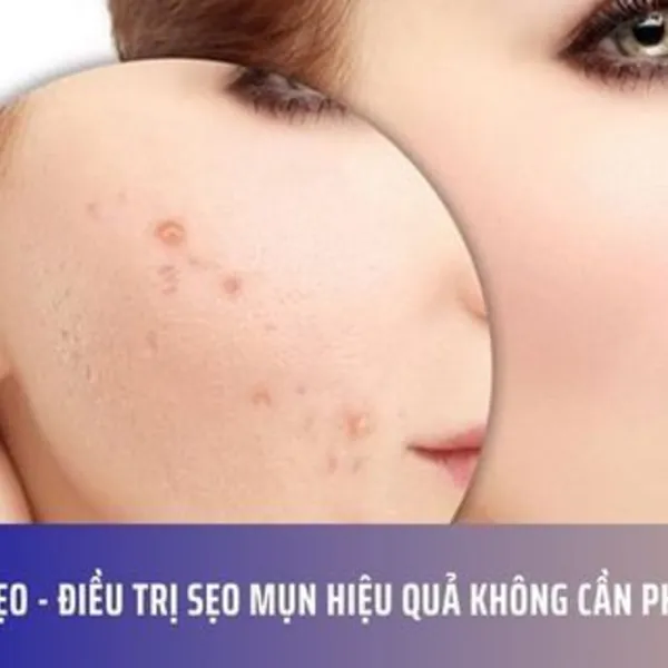 Kem trị sẹo - Điều trị sẹo mụn hiệu quả không cần phẫu thuật