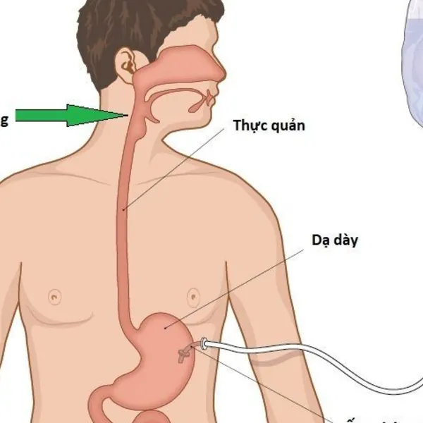 Dinh dưỡng cho bệnh nhân ung thư đầu-cổ