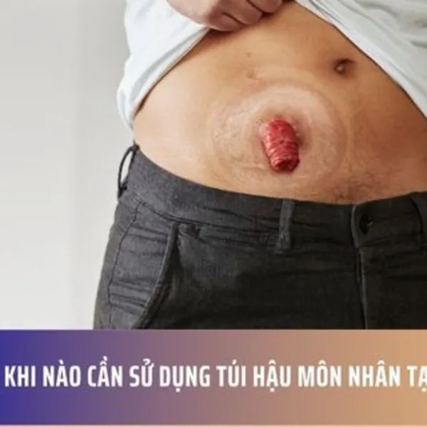 Khi nào cần sử dụng túi hậu môn nhân tạo?
